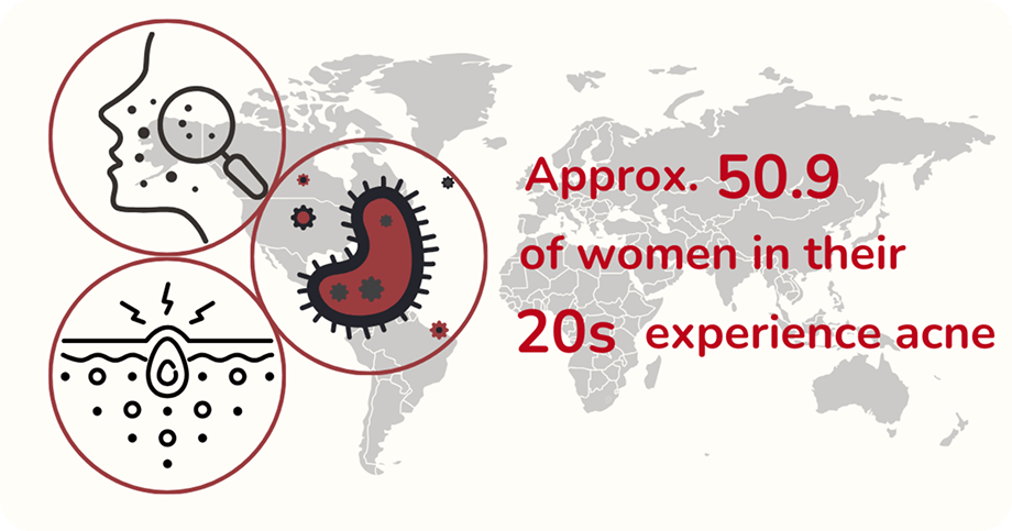 Acne-Prevalence-in-20s