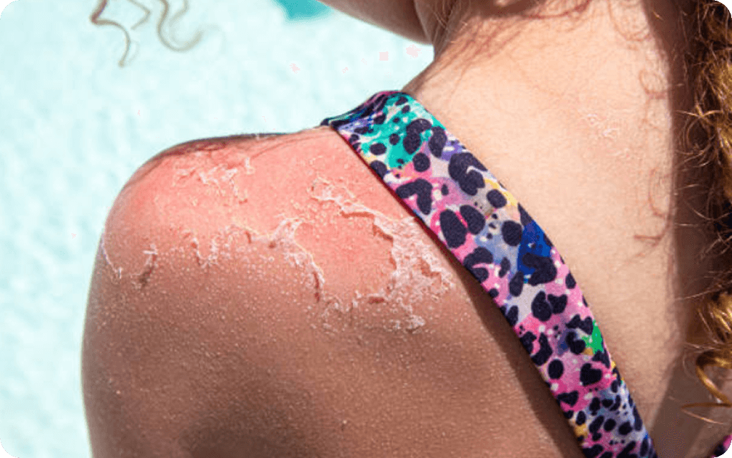 sunburn